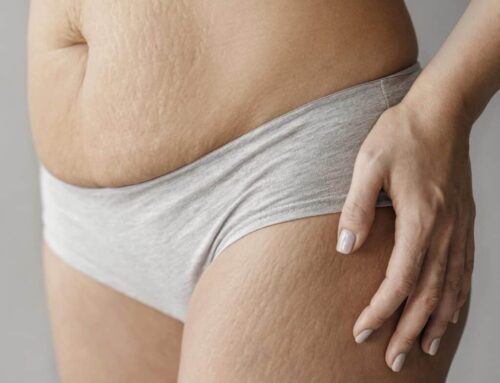 Zabiegi na usuwanie rozstępów