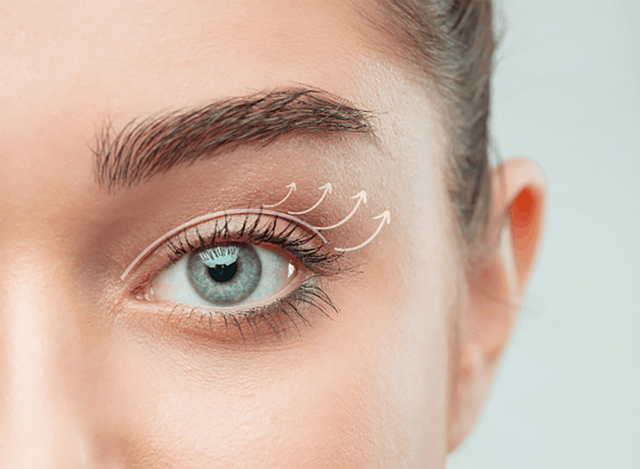 Blefaroplastyka 2