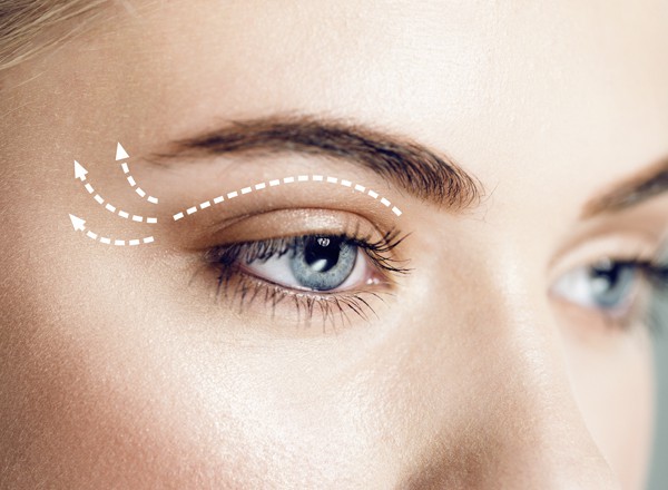 Blefaroplastyka3