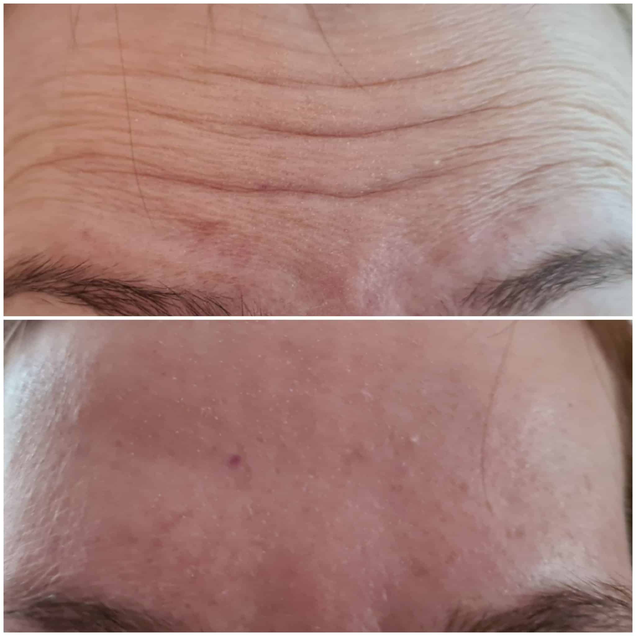 botox przed po 1