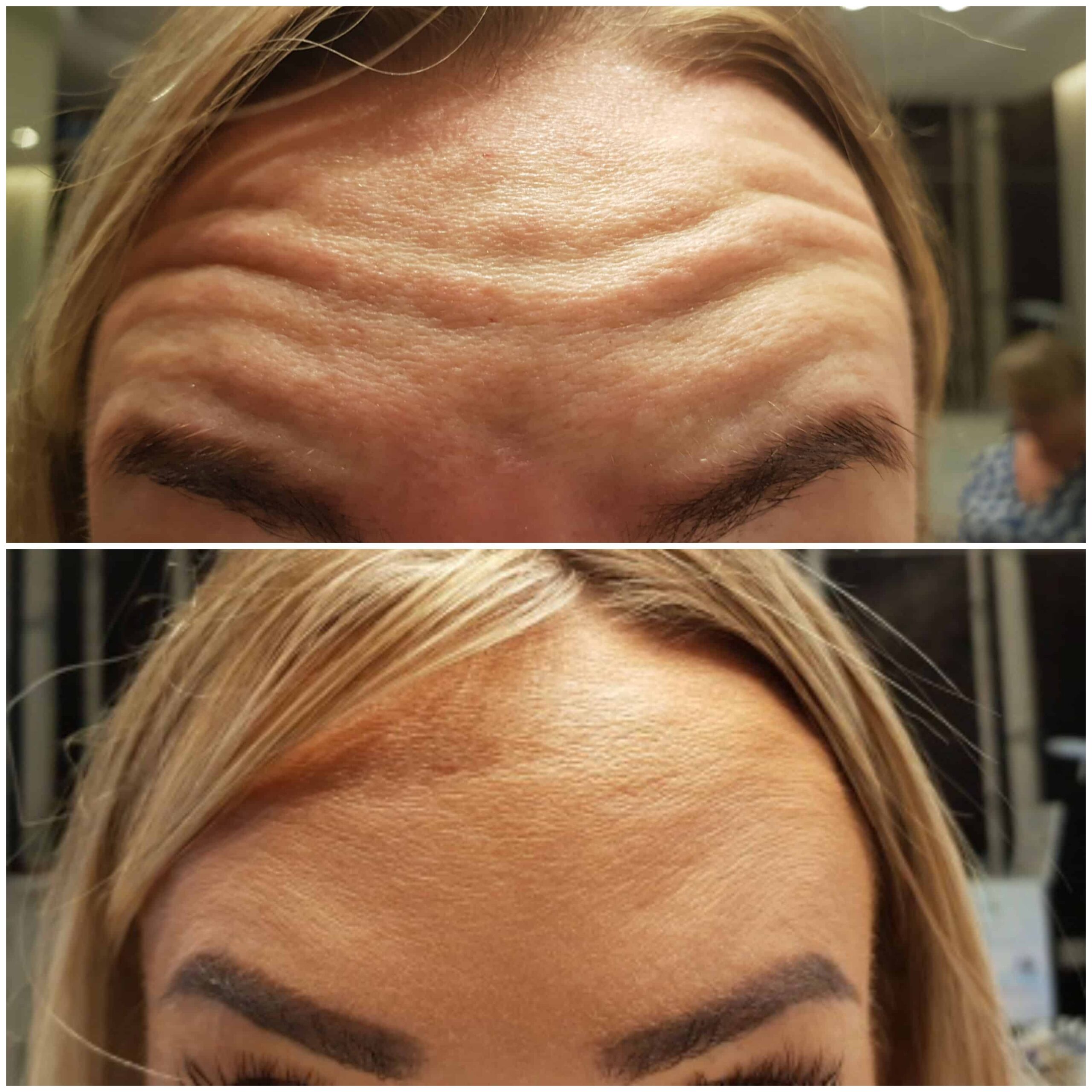 botox przed po 3